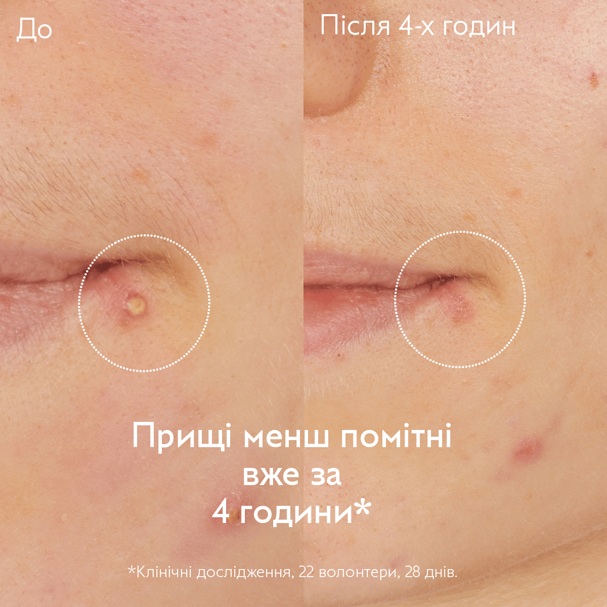 Vinopure SOS Точковий засіб проти недосконалостей із Саліциловою Кислотою